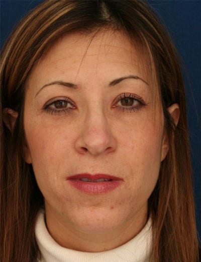 Before Image: Rhinoplasty - front