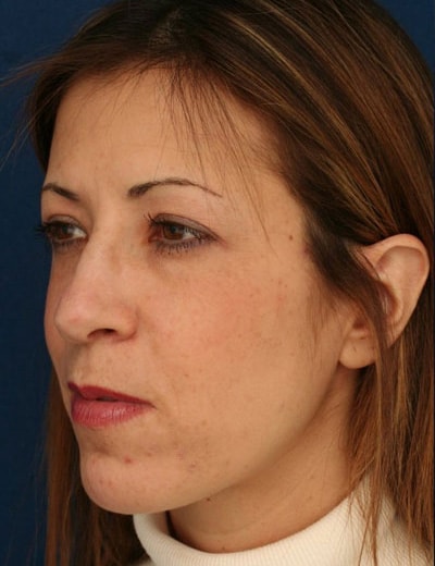 Before Image: Rhinoplasty - left-front-oblique