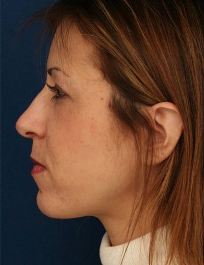 Before Image: Rhinoplasty - left-side