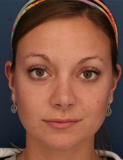 After Image: Rhinoplasty - front