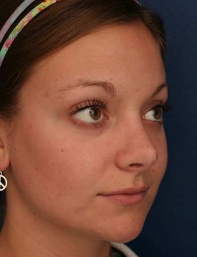 After Image: Rhinoplasty - right-front-oblique