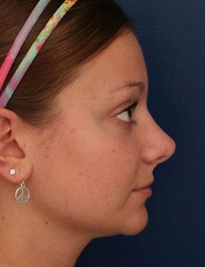 After Image: Rhinoplasty - right-side