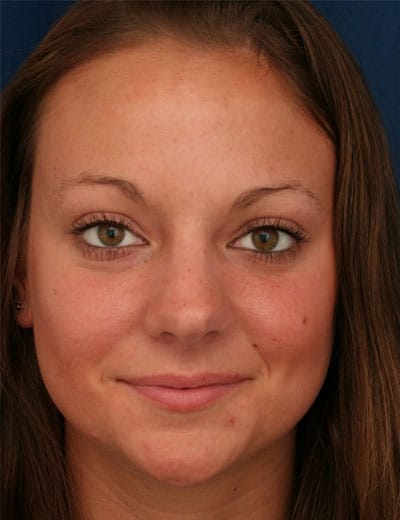 Before Image: Rhinoplasty - front