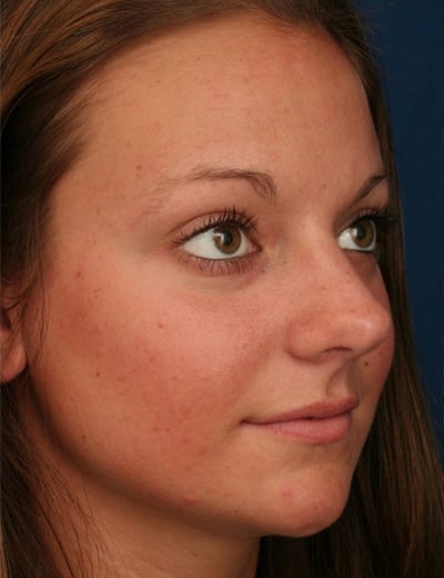 Before Image: Rhinoplasty - right-front-oblique