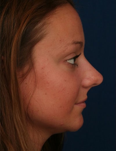 Before Image: Rhinoplasty - right-side