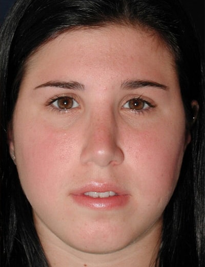 After Image: Rhinoplasty - front