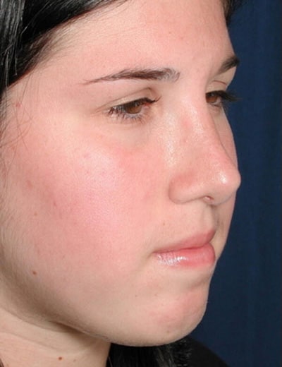 After Image: Rhinoplasty - right-front-oblique