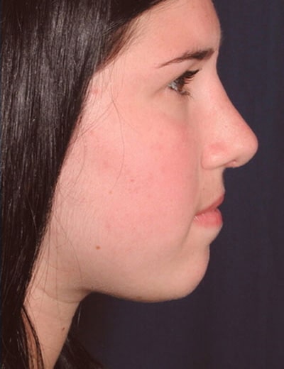 After Image: Rhinoplasty - right-side