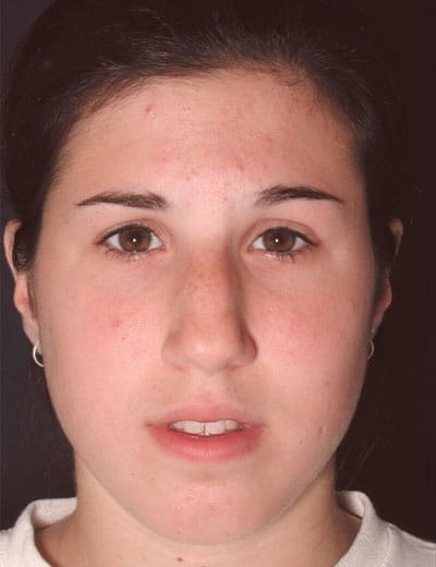 Before Image: Rhinoplasty - front