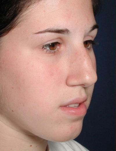 Before Image: Rhinoplasty - right-front-oblique