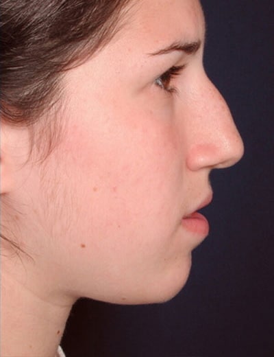 Before Image: Rhinoplasty - right-side