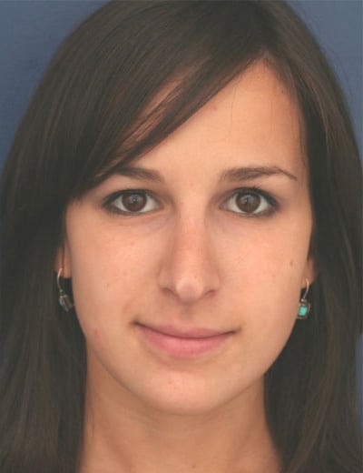 After Image: Rhinoplasty - front