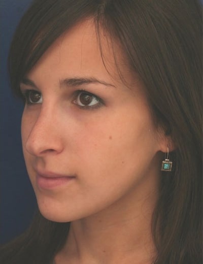 After Image: Rhinoplasty - left-front-oblique
