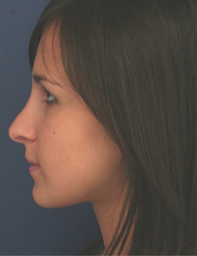 After Image: Rhinoplasty - left-side