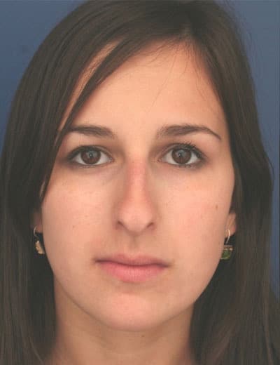 Before Image: Rhinoplasty - front