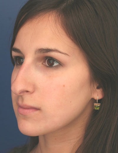 Before Image: Rhinoplasty - left-front-oblique