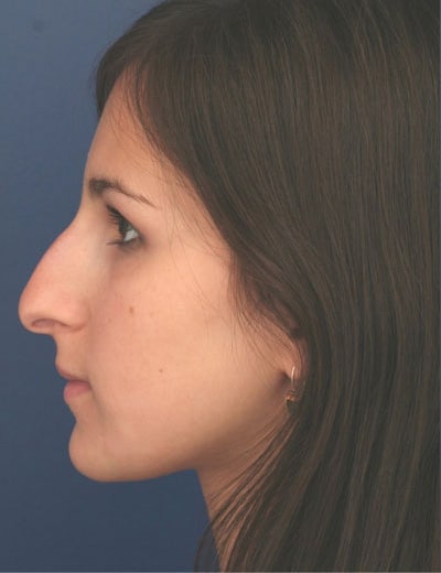 Before Image: Rhinoplasty - left-side