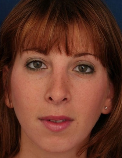 After Image: Rhinoplasty - front