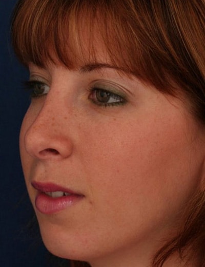 After Image: Rhinoplasty - left-front-oblique