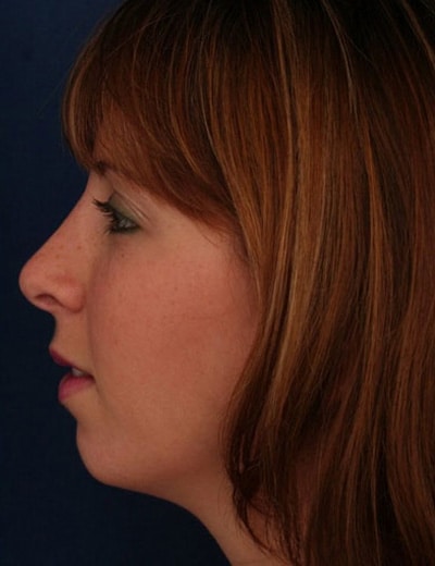 After Image: Rhinoplasty - left-side