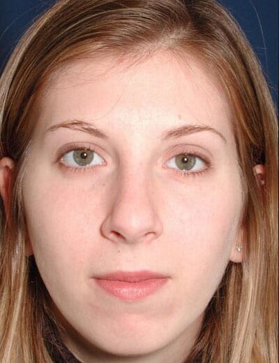 Before Image: Rhinoplasty - front