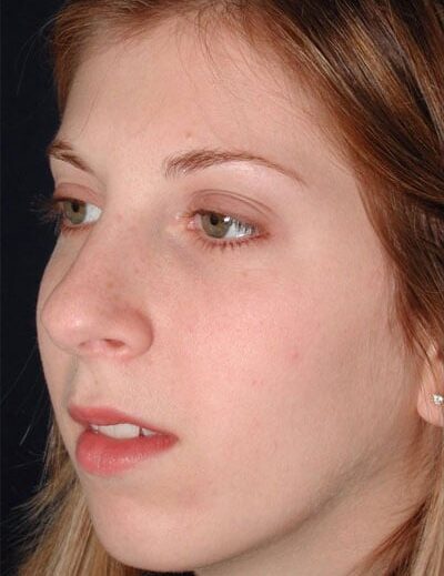 Before Image: Rhinoplasty - left-front-oblique
