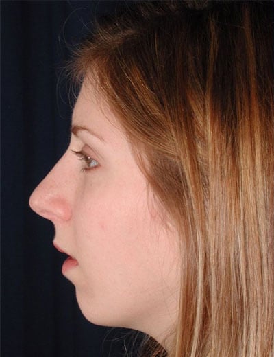 Before Image: Rhinoplasty - left-side