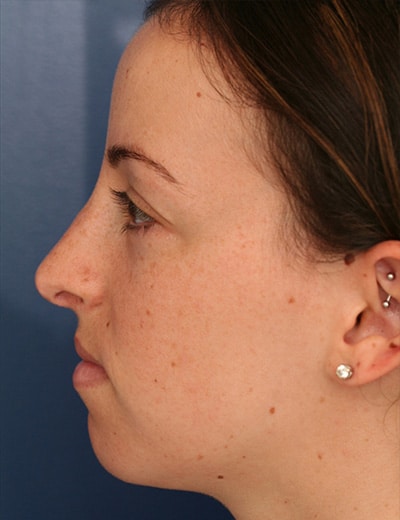 After Image: Rhinoplasty - left-side