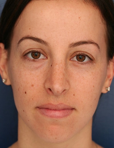 After Image: Rhinoplasty - front