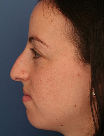 Before Image: Rhinoplasty - left-side