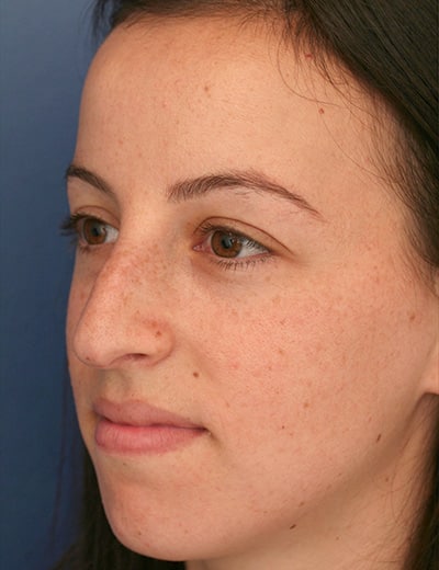 Before Image: Rhinoplasty - left-front-oblique