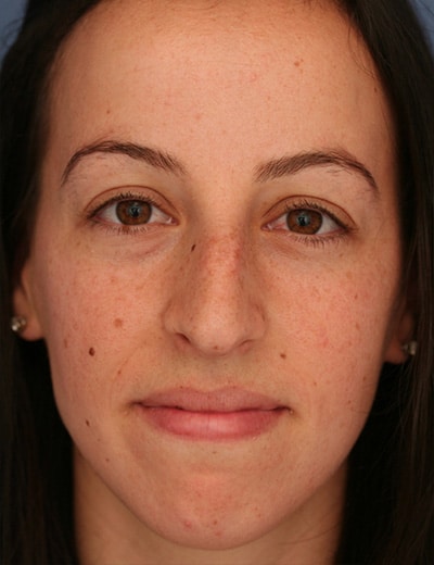 Before Image: Rhinoplasty - front