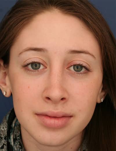 After Image: Rhinoplasty - front