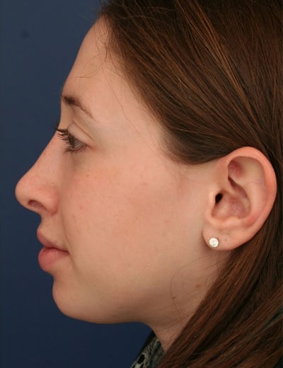 After Image: Rhinoplasty - left-side
