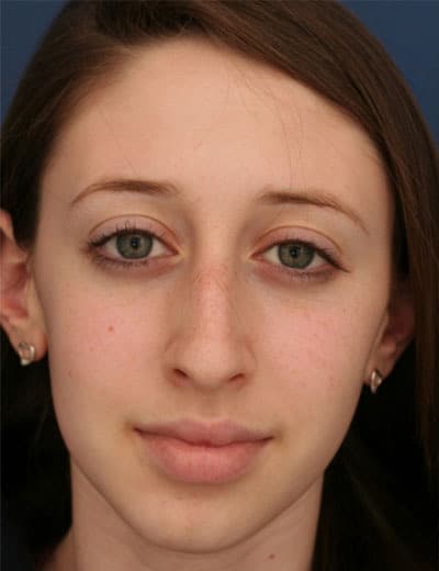 Before Image: Rhinoplasty - front