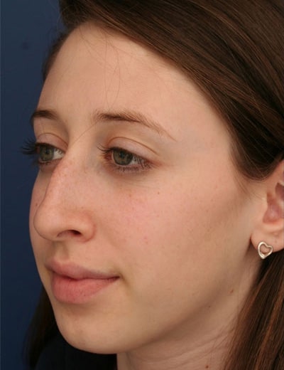 Before Image: Rhinoplasty - left-front-oblique