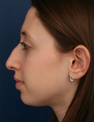 Before Image: Rhinoplasty - left-side