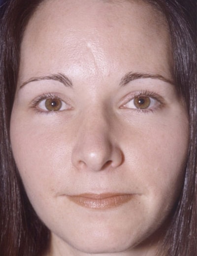 After Image: Rhinoplasty - front