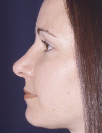 After Image: Rhinoplasty - left-side