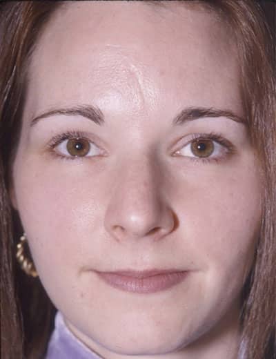 Before Image: Rhinoplasty - front