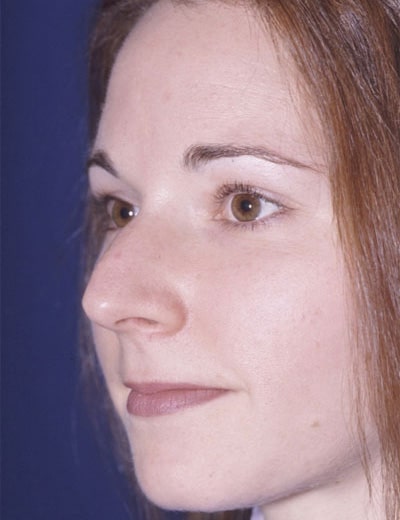 Before Image: Rhinoplasty - left-front-oblique