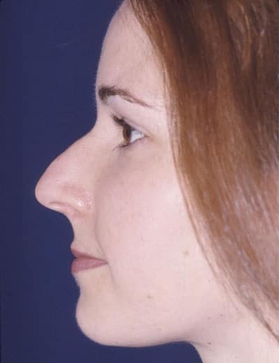 Before Image: Rhinoplasty - left-side