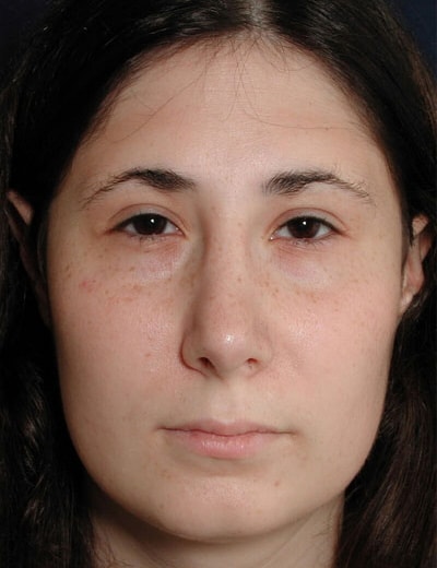 After Image: Rhinoplasty - front