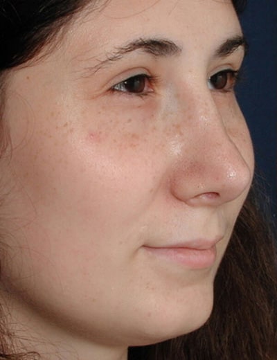 After Image: Rhinoplasty - right-front-oblique