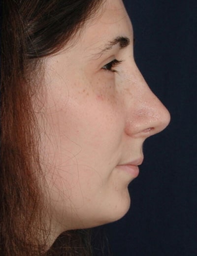 After Image: Rhinoplasty - right-side