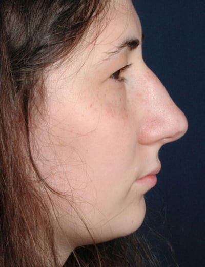 Before Image: Rhinoplasty - right-side