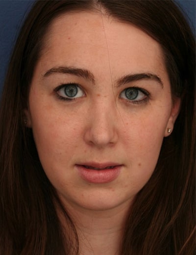After Image: Rhinoplasty - front