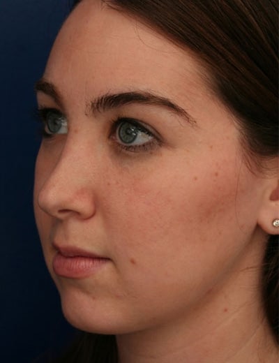 After Image: Rhinoplasty - left-front-oblique