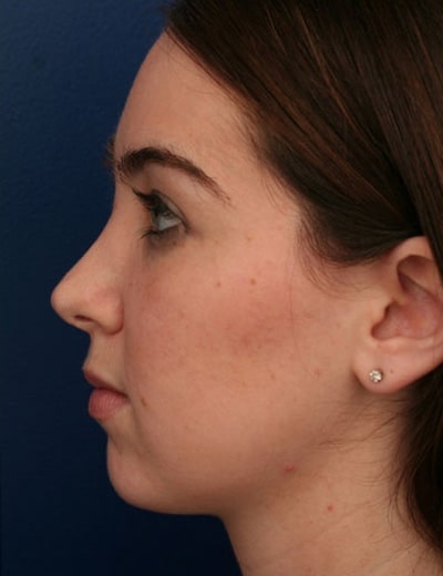 After Image: Rhinoplasty - left-side