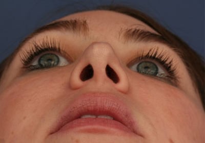After Image: Rhinoplasty - front